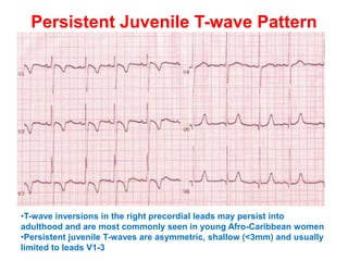 T WAVE IN ECG AND ITS ABNORMALITIES IN ECG | PPTX