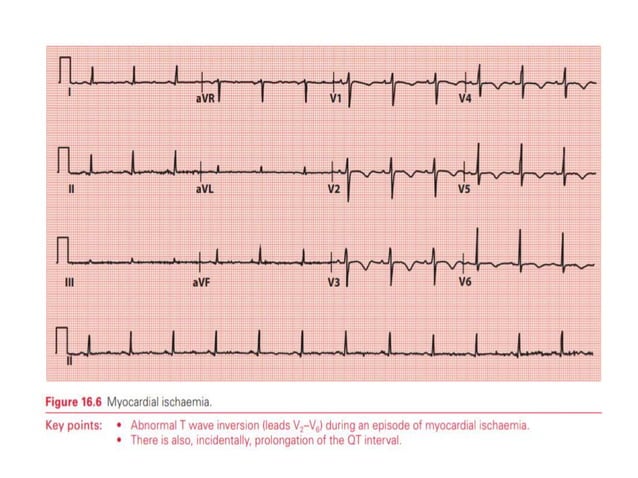T WAVE IN ECG AND ITS ABNORMALITIES IN ECG | PPTX