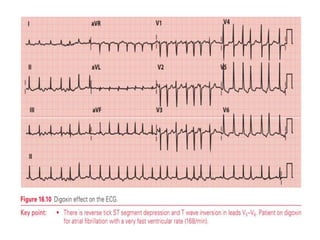 T WAVE IN ECG AND ITS ABNORMALITIES IN ECG | PPTX