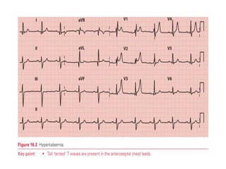 T WAVE IN ECG AND ITS ABNORMALITIES IN ECG | PPTX