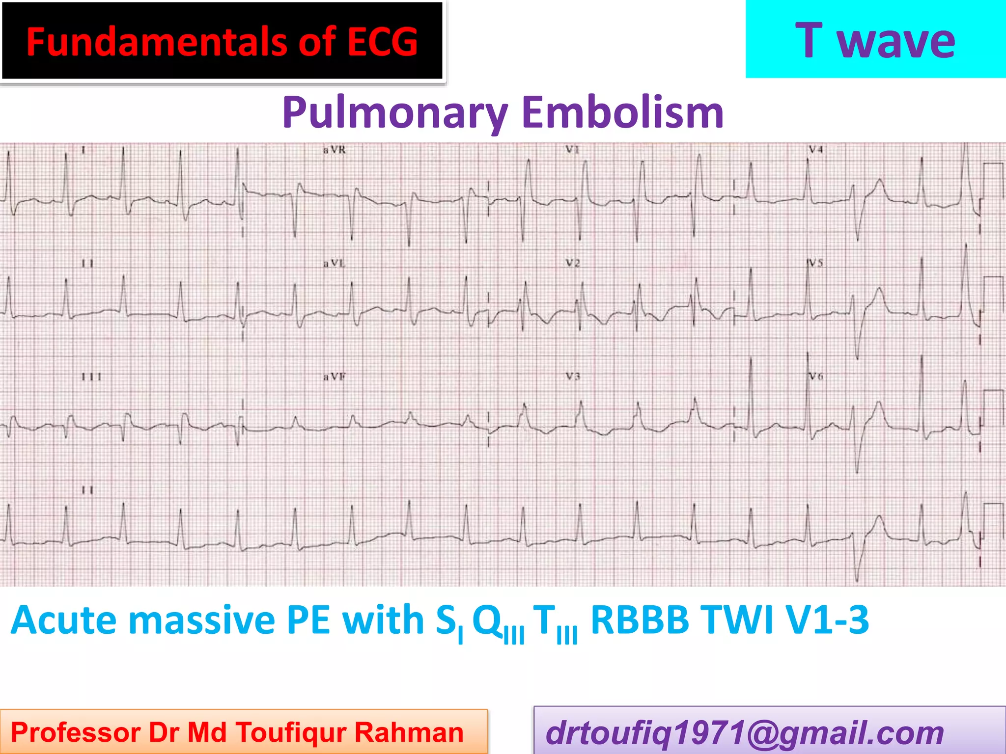 Approach to a patient with t wave abnormality in ecg ppsx