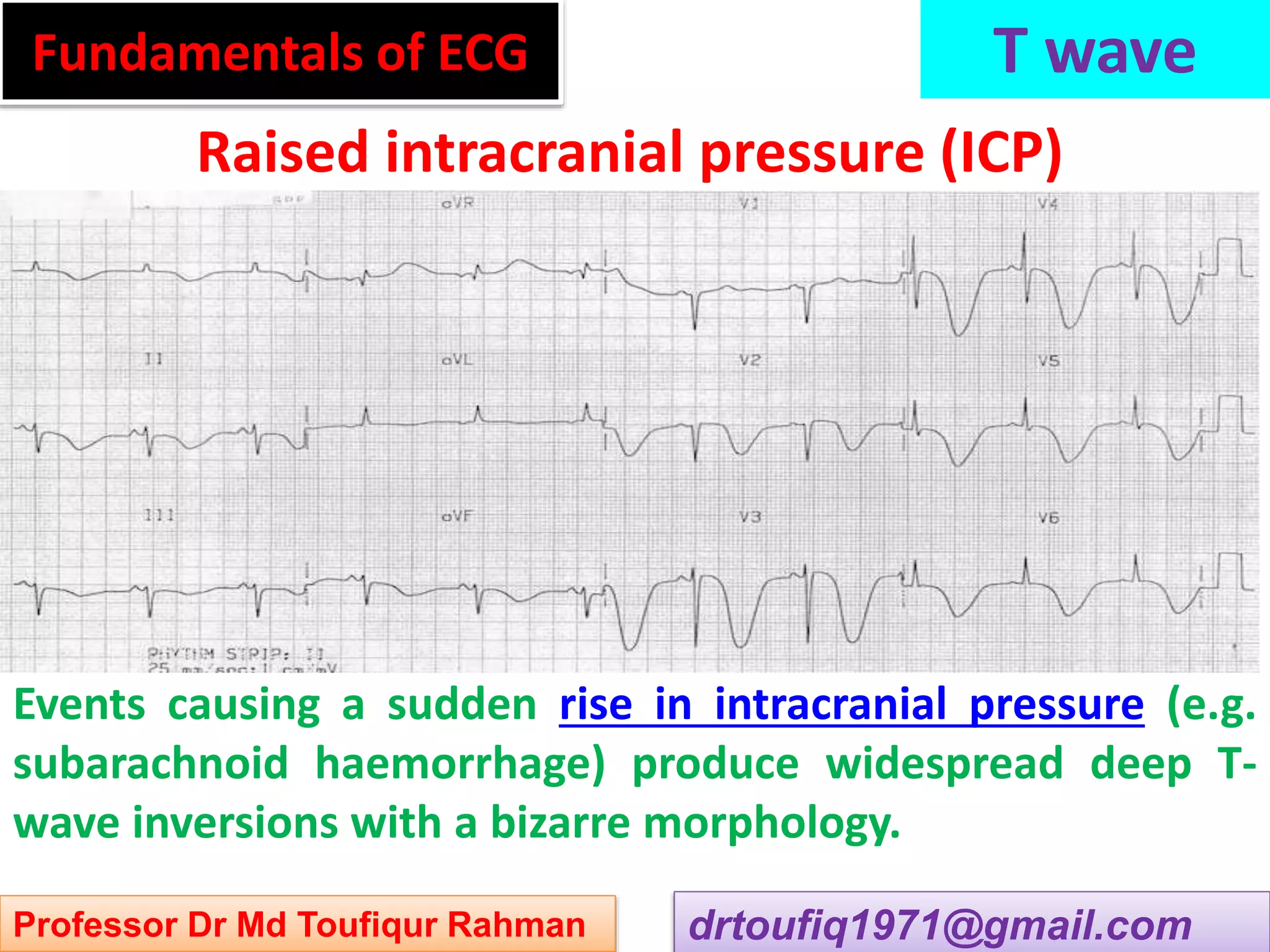 Approach to a patient with t wave abnormality in ecg ppsx