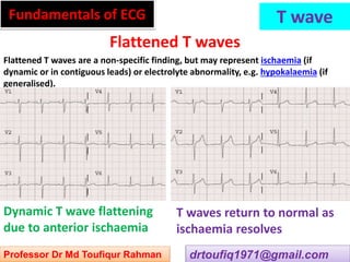 Approach to a patient with T wave abnormality in ECG | PPSX