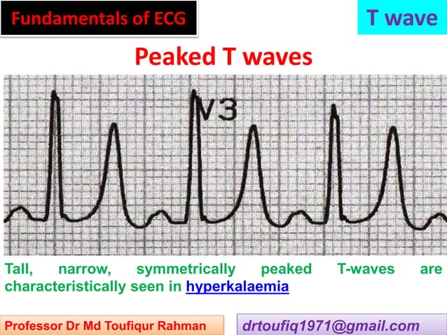 Approach to a patient with T wave abnormality in ECG | PPT