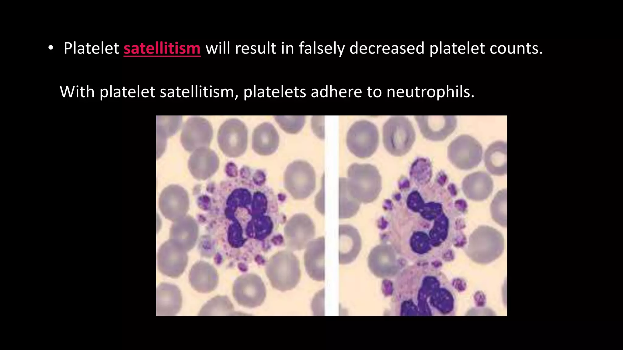 • Platelet satellitism will result in falsely decreased platelet counts.
With platelet satellitism, platelets adhere to neutrophils.
 