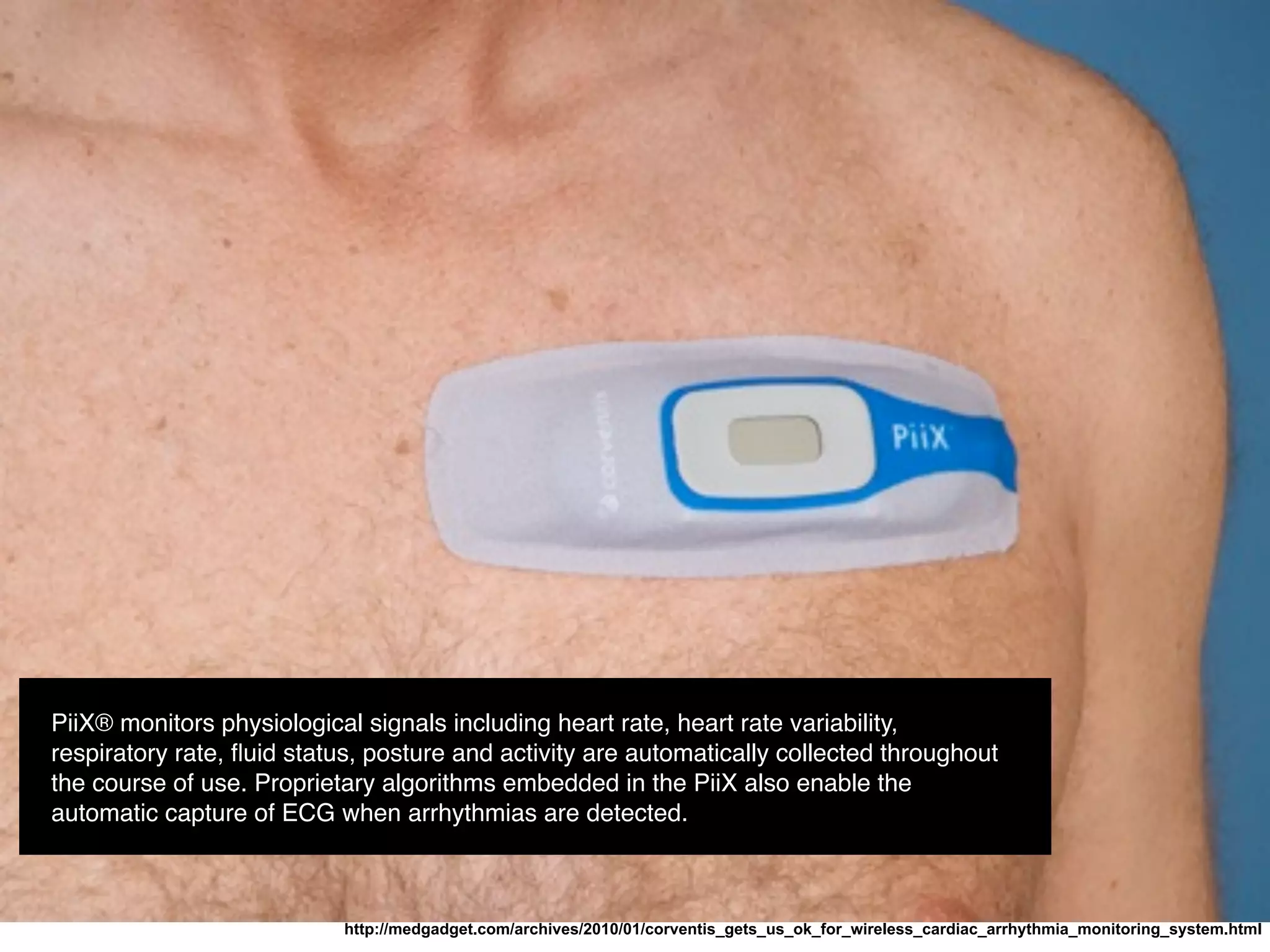 http://medgadget.com/archives/2010/01/corventis_gets_us_ok_for_wireless_cardiac_arrhythmia_monitoring_system.html
PiiX® monitors physiological signals including heart rate, heart rate variability,
respiratory rate, ﬂuid status, posture and activity are automatically collected throughout
the course of use. Proprietary algorithms embedded in the PiiX also enable the
automatic capture of ECG when arrhythmias are detected.
 