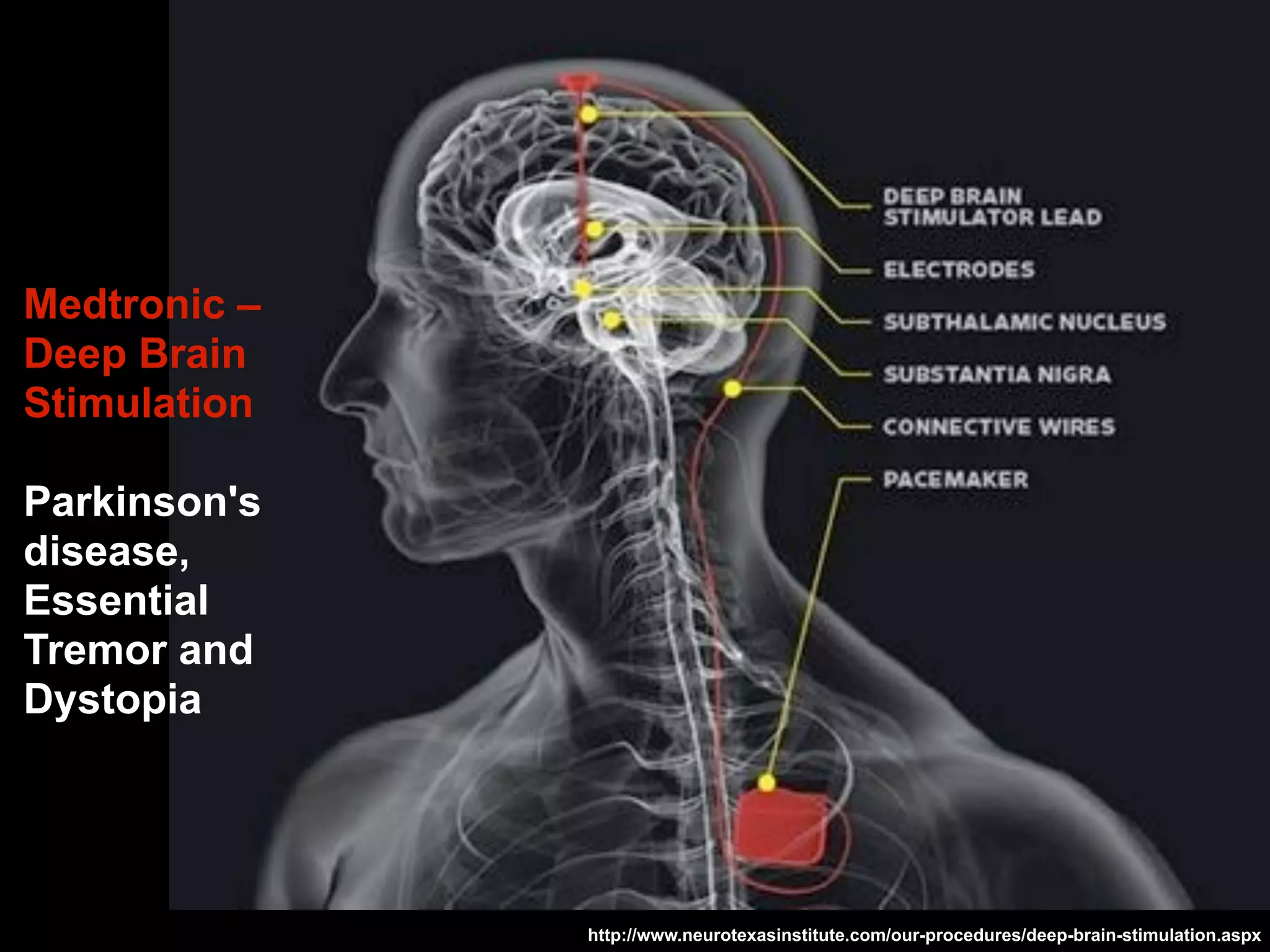 Medtronic –
Deep Brain
Stimulation
Parkinson's
disease,
Essential
Tremor and
Dystopia
http://www.neurotexasinstitute.com/our-procedures/deep-brain-stimulation.aspx
 