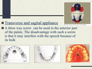 Twin block appliance with torquing spurs and high
pull head gear.
Treatment effects:
Significant increase in maxillary res...