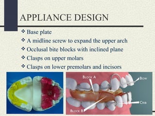 APPLIANCE DESIGN
 Base plate
 A midline screw to expand the upper arch
 Occlusal bite blocks with inclined plane
 Clas...