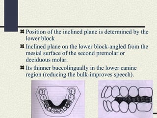 Position of the inclined plane is determined by the
lower block
Inclined plane on the lower block-angled from the
mesial s...