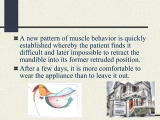 A new pattern of muscle behavior is quickly
established whereby the patient finds it
difficult and later impossible to ret...