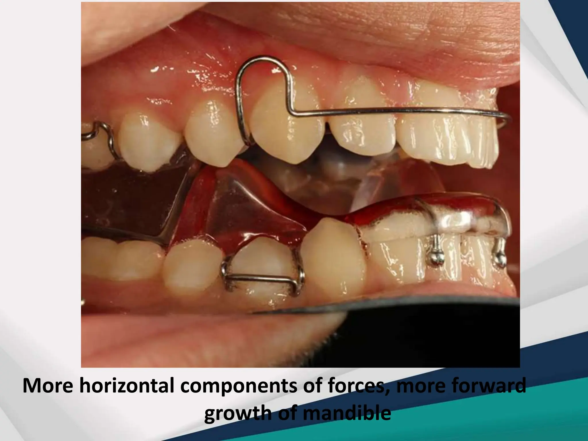 Twin Block appliance in orthodontics .pptx