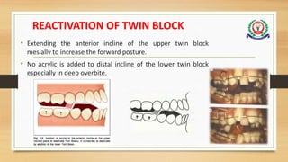 REACTIVATION OF TWIN BLOCK
• Extending the anterior incline of the upper twin block
mesially to increase the forward posture.
• No acrylic is added to distal incline of the lower twin block
especially in deep overbite.
 