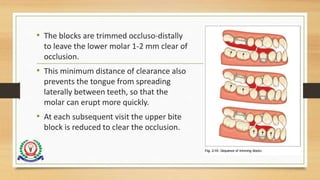 • The blocks are trimmed occluso-distally
to leave the lower molar 1-2 mm clear of
occlusion.
• This minimum distance of clearance also
prevents the tongue from spreading
laterally between teeth, so that the
molar can erupt more quickly.
• At each subsequent visit the upper bite
block is reduced to clear the occlusion.
 