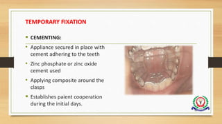 TEMPORARY FIXATION
 CEMENTING:
• Appliance secured in place with
cement adhering to the teeth
• Zinc phosphate or zinc oxide
cement used
• Applying composite around the
clasps
 Establishes paient cooperation
during the initial days.
76
 