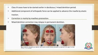 • Class III cases have to be started earlier in deciduous / mixed dentition period.
• Additional component of orthopedic force can be applied to advance the maxilla by elastic
traction.
• Correction is mainly by maxillary protraction.
• Mixed dentition correction may relapse in permanent dentition.
 