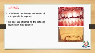 86
LIP PADS
• To enhance the forward movement of
the upper labial segment.
• Lip pads are attached to the anterior
segment of the appliance.
 