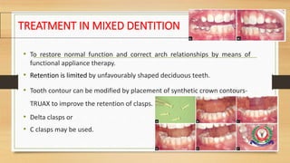 TREATMENT IN MIXED DENTITION
• To restore normal function and correct arch relationships by means of
functional appliance therapy.
• Retention is limited by unfavourably shaped deciduous teeth.
• Tooth contour can be modified by placement of synthetic crown contours-
TRUAX to improve the retention of clasps.
• Delta clasps or
• C clasps may be used.
90
 