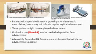 • Patients with open bite & vertical growth pattern have weak
musculature, hence may not tolerate regular sagittal advancement.
• These patients might require phased advancement.
• Occlusal screw (Geserick) can be used which provides 6mm
advancement.
• Alternately, Carmichael & Banks screw may be used but with lesser
advancements possible.
 