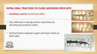 INTRA ORAL TRACTION TO CLOSE ANTERIOR OPEN BITE
• INTRAORAL ELASTICS- Dr.Christine Mills
• Very effective in closing anterior open bites by
intruding the posterior teeth.
• Vertical Elastics between upper and lower teeth on
both sides.
99
 