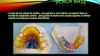 • Consta de dos placas de acrílico, una superior y otra inferior, la superior lleva un
tornillo de expansión central para ajustar el ancho de la arcada superior al inferior
cuando se produce el avance mandibular.
 