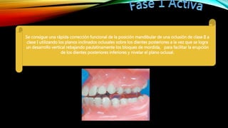 Se consigue una rápida corrección funcional de la posición mandibular de una oclusión de clase II a
clase I utilizando los planos inclinados oclusales sobre los dientes posteriores a la vez que se logra
un desarrollo vertical rebajando paulatinamente los bloques de mordida, para facilitar la erupción
de los dientes posteriores inferiores y nivelar el plano oclusal.
 