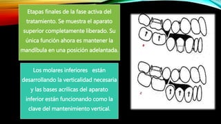 Etapas finales de la fase activa del
tratamiento. Se muestra el aparato
superior completamente liberado. Su
única función ahora es mantener la
mandíbula en una posición adelantada.
Los molares inferiores están
desarrollando la verticalidad necesaria
y las bases acrílicas del aparato
inferior están funcionando como la
clave del mantenimiento vertical.
 