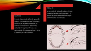 FIGURA 3D.
Presenta el aparato de la fase de apoyo. Se
muestra la rampa anterior que mantiene la
corrección de la clase II mandibular; los
molares mantienen ahora el desarrollo
vertical. Las bicúspides inferiores y los
caninos están libres para erupcionar hacia
la oclusión con el arco superior.
FIGURA 3E.
La corrección de la clase II está completada.
El paciente ha desarrollado una clase I. El
aparato de apoyo se mantiene para lograr
la estabilidad en la contención.
 