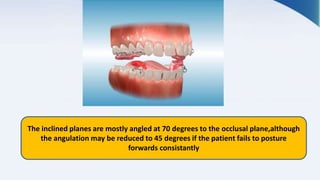 The inclined planes are mostly angled at 70 degrees to the occlusal plane,although
the angulation may be reduced to 45 degrees if the patient fails to posture
forwards consistantly
 