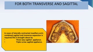 FOR BOTH TRANSVERSE AND SAGITTAL
In cases of laterally contracted maxillary arch;
combined sagittal and tranverse expansion is
required.This is brought about by
• Three way sagittal appliance.
• Triple screw sagittal appliance.
 