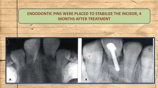 ENDODONTIC PINS WERE PLACED TO STABILIZE THE INCISOR, 4
MONTHS AFTER TREATMENT
 
