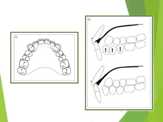 105
A,B Support phase-anterior
inclined plane
 