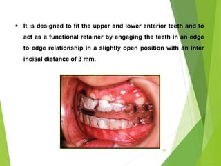 109
 It is designed to fit the upper and lower anterior teeth and to
act as a functional retainer by engaging the teeth in an edge
to edge relationship in a slightly open position with an inter
incisal distance of 3 mm.
 