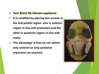 123
 Twin Block Mc Namara appliance:
 It is modified by placing two screws in
the mid palatal region -one in anterior
region in line with premolars and the
other in posterior region in line with
molar.
 The advantage is that we can obtain
only anterior or only posterior
expansion as required.
 