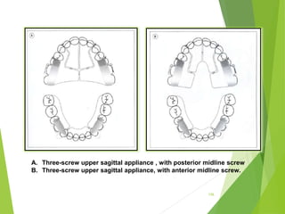 126
A. Three-screw upper sagittal appliance , with posterior midline screw
B. Three-screw upper sagittal appliance, with anterior midline screw.
 