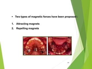 137
 Two types of magnetic forces have been proposed :
1. Attracting magnets
2. Repelling magnets
 