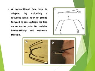 144
 A conventional face bow is
adapted by soldering a
recurved labial hook to extend
forward to rest outside the lips
as an anchor point to combine
intermaxillary and extraoral
traction.
 