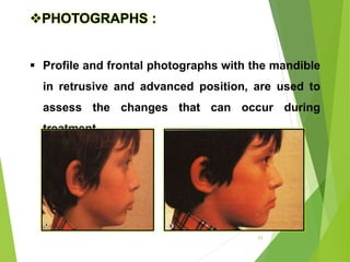23
PHOTOGRAPHS :
 Profile and frontal photographs with the mandible
in retrusive and advanced position, are used to
assess the changes that can occur during
treatment.
 