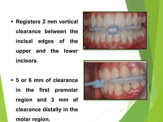  Registers 2 mm vertical
clearance between the
incisal edges of the
upper and the lower
incisors.
 5 or 6 mm of clearance
in the first premolar
region and 3 mm of
clearance distally in the
molar region.
42
 