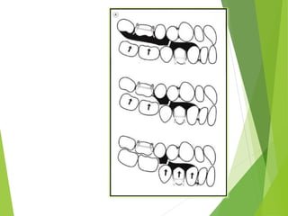  The occlusion is freed
between the posterior
teeth to encourage
selective eruption of
posterior tooth to
increase the vertical
dimension of
occlusion in the
posterior quadrants.
56
 