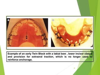 68
Example of an early Twin Block with a labial bow , lower incisor clasps
and provision for extraoral traction, which is no longer used to
reinforce anchorage.
 
