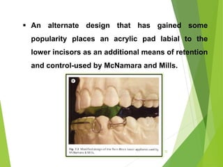 72
 An alternate design that has gained some
popularity places an acrylic pad labial to the
lower incisors as an additional means of retention
and control-used by McNamara and Mills.
 