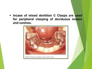 79
 Incase of mixed dentition C Clasps are used
for peripheral clasping of deciduous molars
and canines.
 