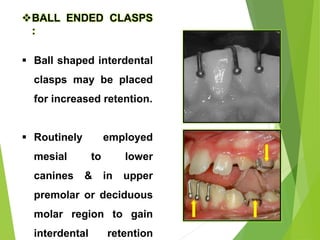80
BALL ENDED CLASPS
:
 Ball shaped interdental
clasps may be placed
for increased retention.
 Routinely employed
mesial to lower
canines & in upper
premolar or deciduous
molar region to gain
interdental retention
 
