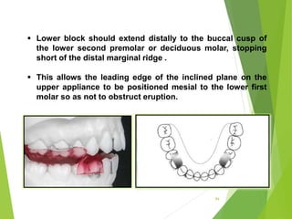 84
 Lower block should extend distally to the buccal cusp of
the lower second premolar or deciduous molar, stopping
short of the distal marginal ridge .
 This allows the leading edge of the inclined plane on the
upper appliance to be positioned mesial to the lower first
molar so as not to obstruct eruption.
 