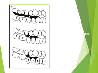 92
Sequence of trimming blocks
 