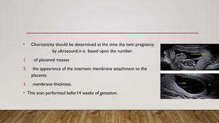 Twin Gestation Pptx Types Complications Pptx