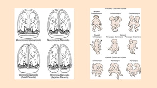 multiple pregnancy | PPTX