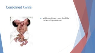 Conjoined twins
 viable conjoined twins should be
delivered by caesarean
 