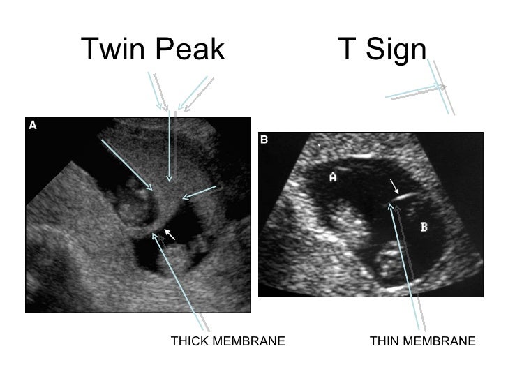 Twins clinical management 2012